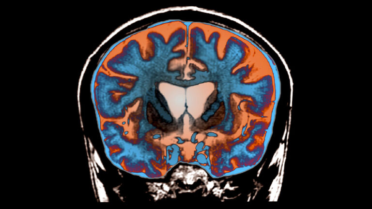 This image shows an MRI scan of the brain of someone with Huntington
