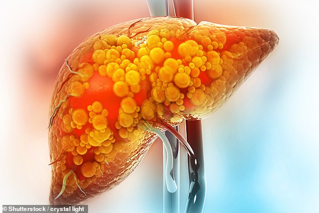 I barely touch even a drop of alcohol but I was diagnosed with liver disease – this is what I’m doing to reverse it The 36-year-old shared which foods she's cutting out from her diet to reverse her NAFLD