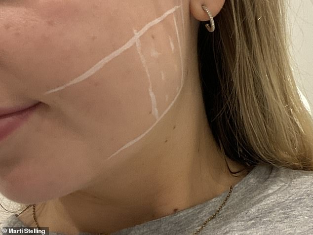 I spent years waking up with splintering headaches from grinding my teeth – then I tried Botox at 24 A plastic surgeon drew the incision points on my jawline before injecting the Botox